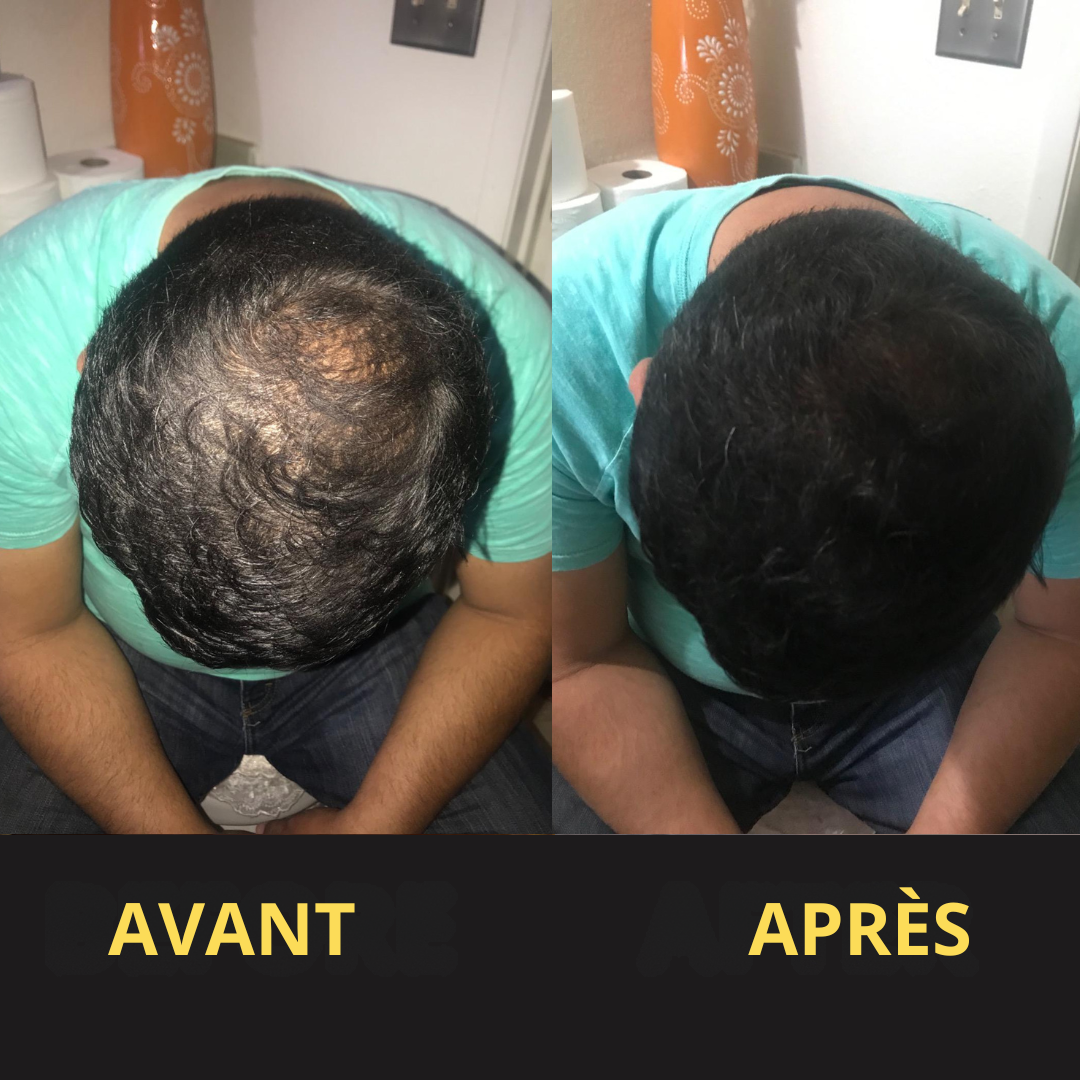 Solution Capillaire - Dermacap