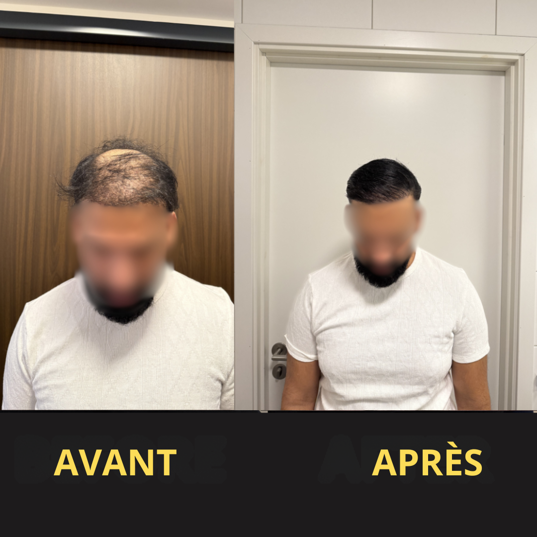 Solution Capillaire - Dermacap